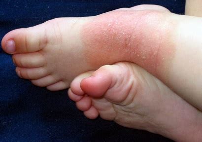 Foot Eczema: Causes, Symptoms & Treatment - Foot Pain Explored