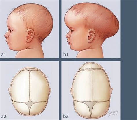 Craniosynostosis Symptoms | craniosynostosis | Publish with Glogster ...