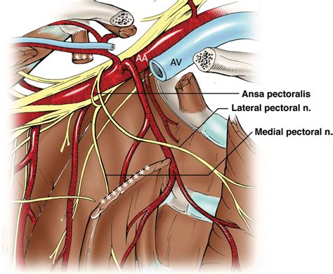 Medial Pectoral Nerve