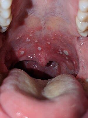 What Causes Blisters In Throat