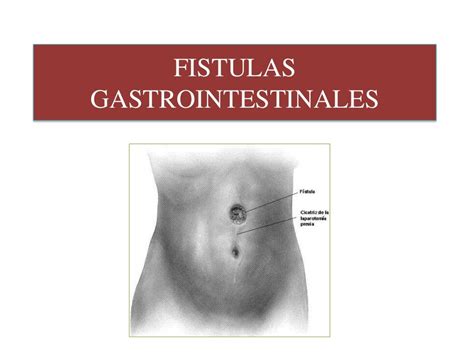 Fistulas