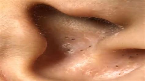 Blackheads Removal Biggest Extraction - Blackhead Popping in Ear - YouTube