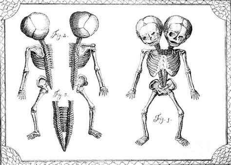 Conjoined twins, Character design, Art