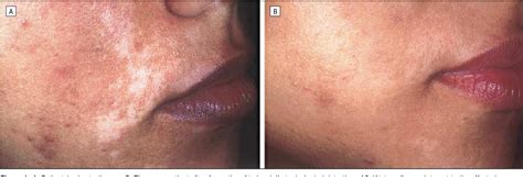 Figure 1 from Successful treatment of vitiligo with 0.1% tacrolimus ...