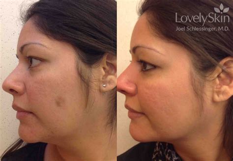 Mole Removal Before and After Photos