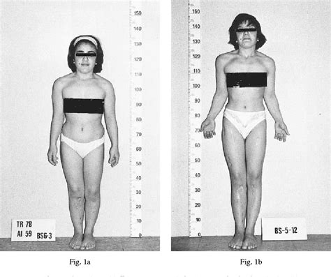 Figure 1 from Leg lengthening in Turner dwarfism. | Semantic Scholar