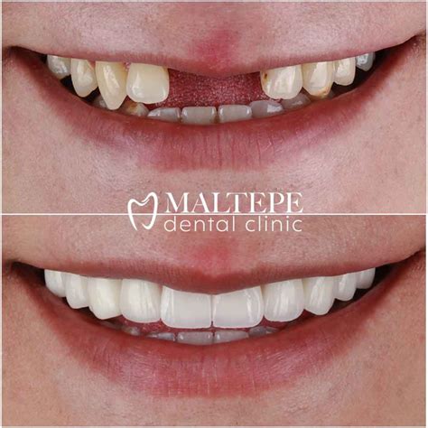 Dental bridge: Definition, Types, Who Needs It, Cost, Treatment, and More - Maltepe Dental Clinic