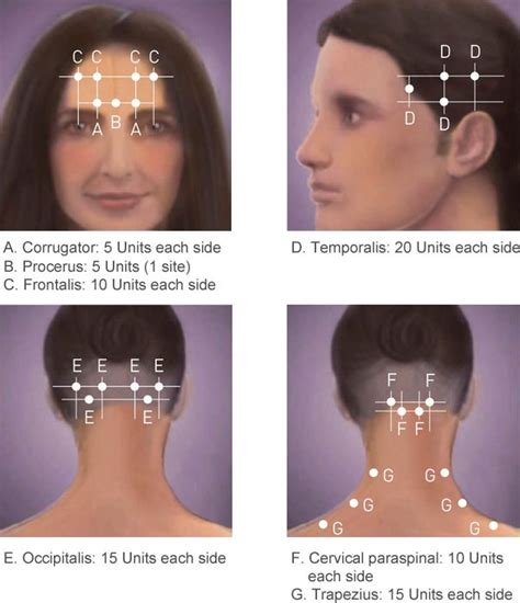 Botox Injection Sites For Migraines Diagram Botox For Migrai