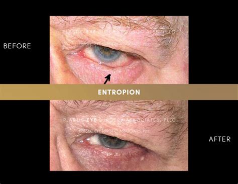 Ectropion Entropion Photos - Plastic Eye Surgery Associates