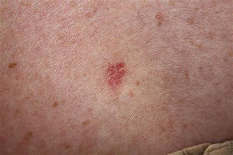 Skin carcinomas linked to increased risk of other cancers