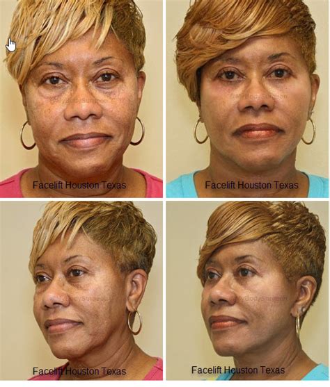 Facelift Surgery in Houston Texas - Rioux Vision