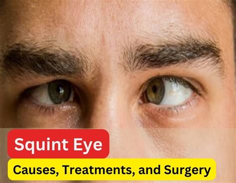 Squint Eye: Understanding Causes, Treatments, and Surgery - Iris Eye Care