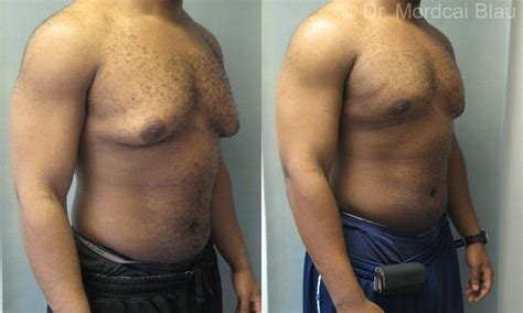 Severe Gynecomastia - Before and After Photos ⋆ Gynecomastia USA