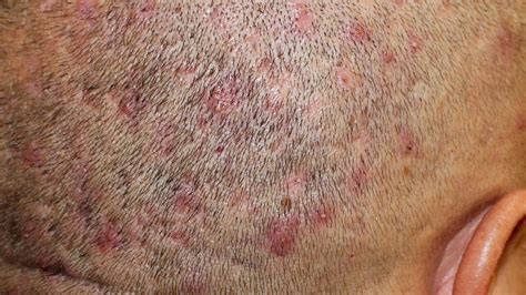 Folliculitis Scalp