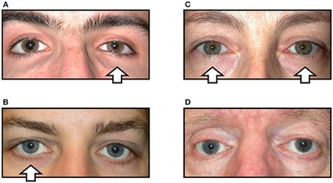 Frontiers | Apraclonidine Is Better Than Cocaine for Detection of Horner Syndrome