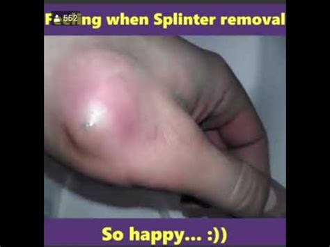 Splinter removal - YouTube