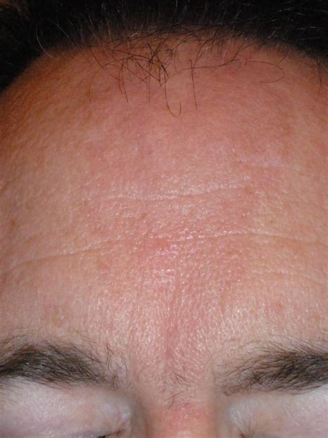 Forehead Rash Causes