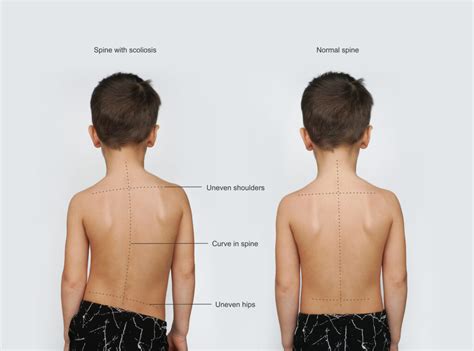 What are some signs of scoliosis? – Scoliosis Knowledge Hub