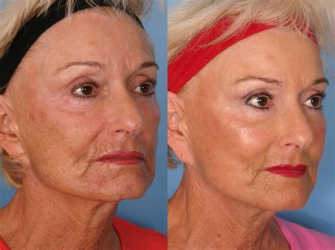 Sculptra® Before and After Pictures Case 64 | Naples and Ft. Myers, FL | Kent V. Hasen, MD ...