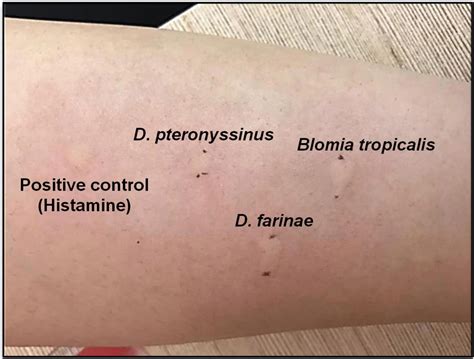 Frontiers | Allergic Rhinitis: A Clinical and Pathophysiological Overview