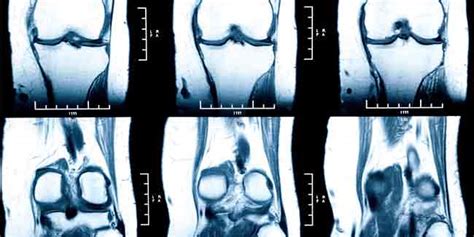 Secondery Bone Cancer - CancerWalls