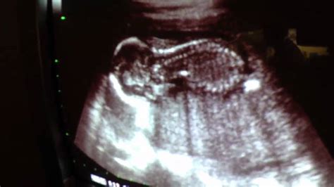 Melissa - Ultrasound 17 weeks - YouTube