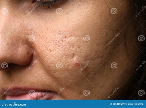 Inflamed Skin on the Face. Acne. Pimples on the Skin. Scars and Peeling. Stock Image - Image of ...