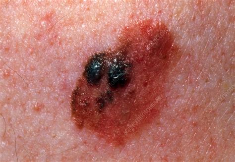 Close-up of a malignant melanoma on an elderly man - Stock Image - M131 ...