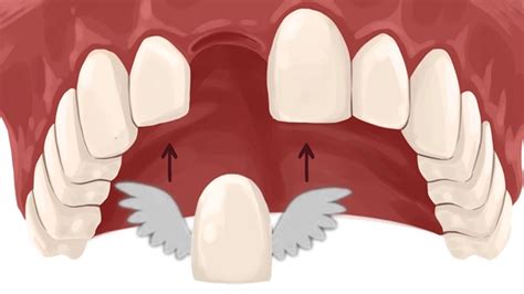 Resin Retained Bridges Simplified In 10 Short Minutes! | Ace Courses Webinar Summary | Two Dentists