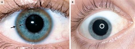 Kayser–Fleischer Rings in Wilson's Disease | NEJM