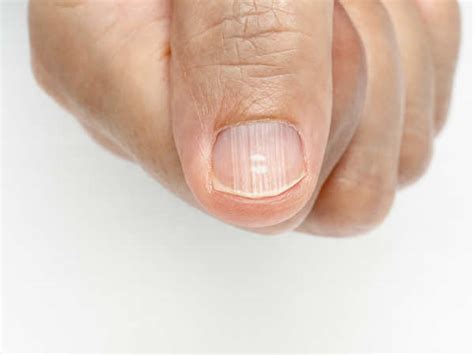 Ridges In Fingernails: Symptoms, Causes, And Treatments, 40% OFF