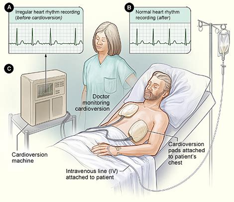 Cardioversion - Baltimore Cardiologists - Woodholme Cardiovascular Associates