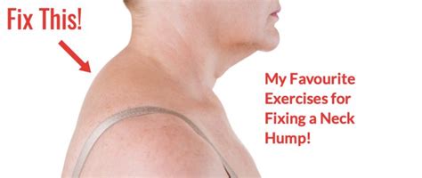 neck hump email | Milton Chiropractic Clinic