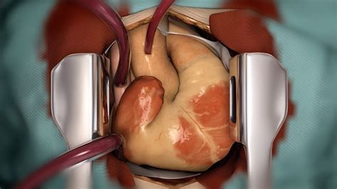 Heart Transplantation - a treatment for heart failure - YouTube