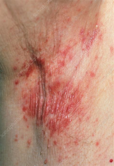 MRSA bacterial infection in skin in man's armpit - Stock Image - M180/0088 - Science Photo Library