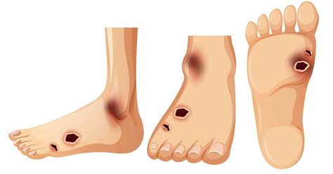 Diabetic Foot Disease: Prevention is better than cure!