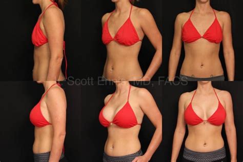 Endoscopic Breast Augmentation in Palm Beach at Ennis Plastic Surgery