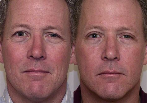 Eyelid Surgery (Blepharoplasty) Before and After Pictures Case 5 | Atlanta, Georgia | Buckhead ...