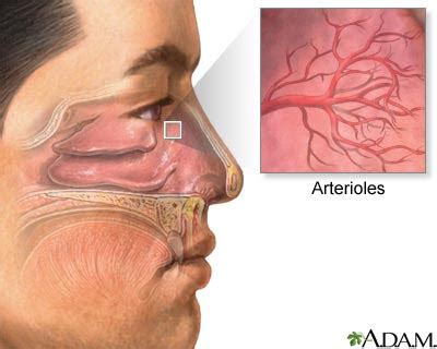 Just Health: What To Do When You Have A Bleeding Nose