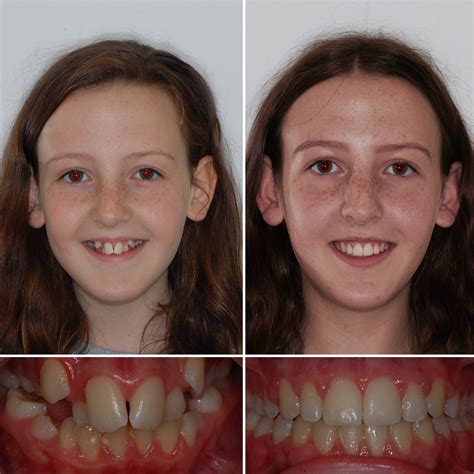 Metal Braces Before And After