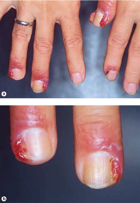 Figure 1 from Development of Multiple Paronychia and Periungual ...