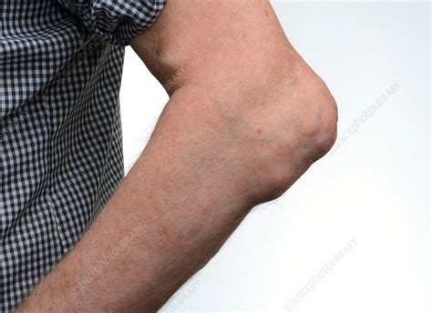 Gout tophi in the elbow - Stock Image - C014/2460 - Science Photo Library