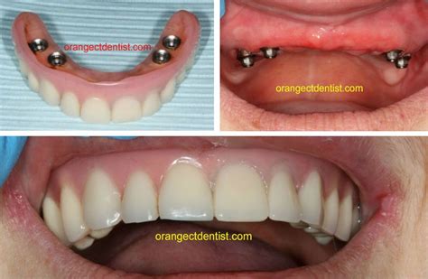 Full Dental Implants Near Me | ucmj attorney