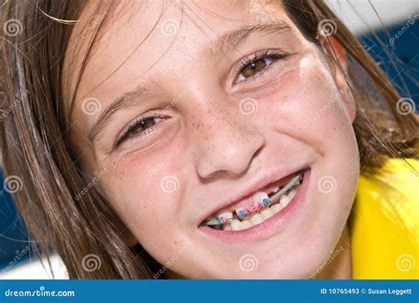 Close Up Girl With Braces Stock Photos - Image: 10765493