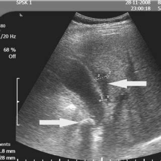 Ultrasound findings in acute cholecystitis that could affect the... | Download Scientific Diagram