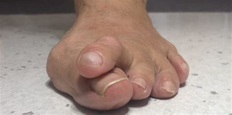 Hammer Toes: Causes, Diagnosis, Treatment - Foot And Ankle