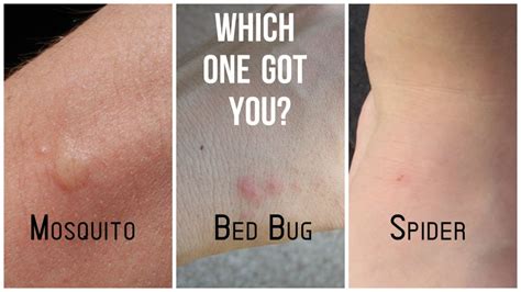 How Long Does A Bed Bug Bite Take To Heal at Tina Reinhardt blog