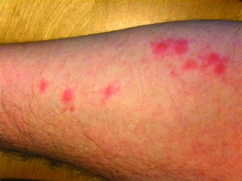 What Do Bed Bug Bites Look Like? | ABC Blog