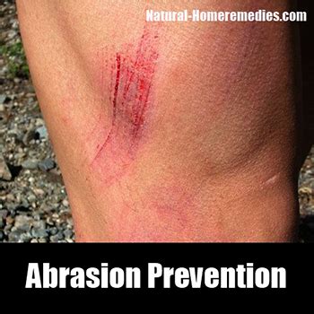 Home Remedies for Abrasions – Treatment & Cure – Natural Remedy for Abrasions – Abrasions Diet