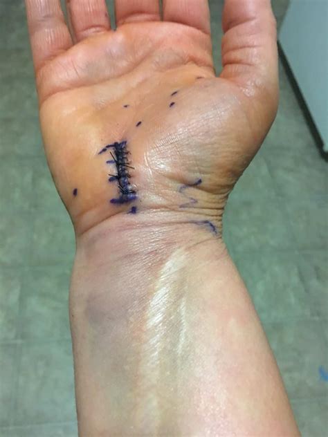 Carpal Tunnel Surgery Recovery: 3 Months Later - 24/7 Modern Mom ...